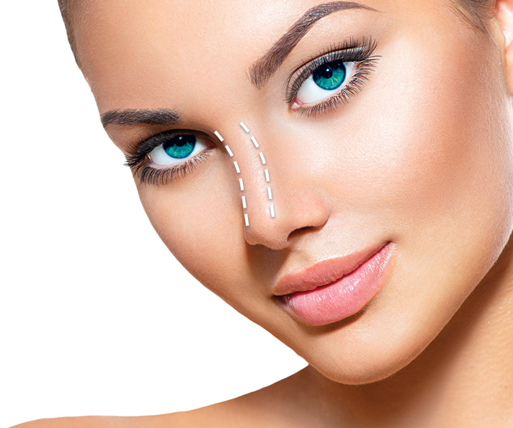 Dermal filler treatment